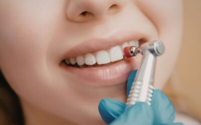 Limpieza dental profesional: cada cuánto y por qué importa