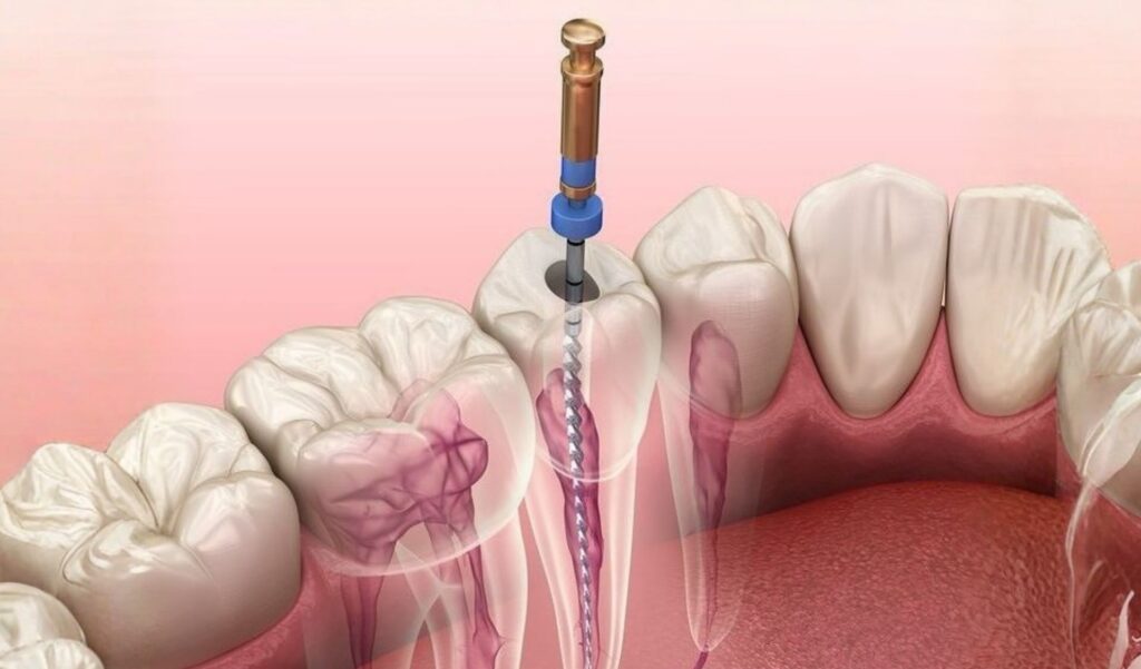 Endodoncia