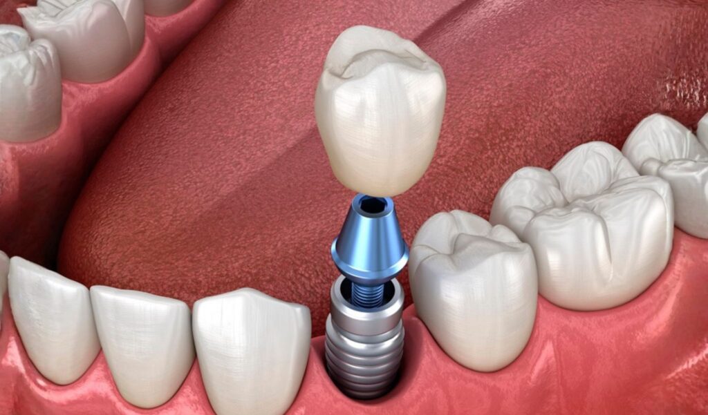 Implantes Dentales