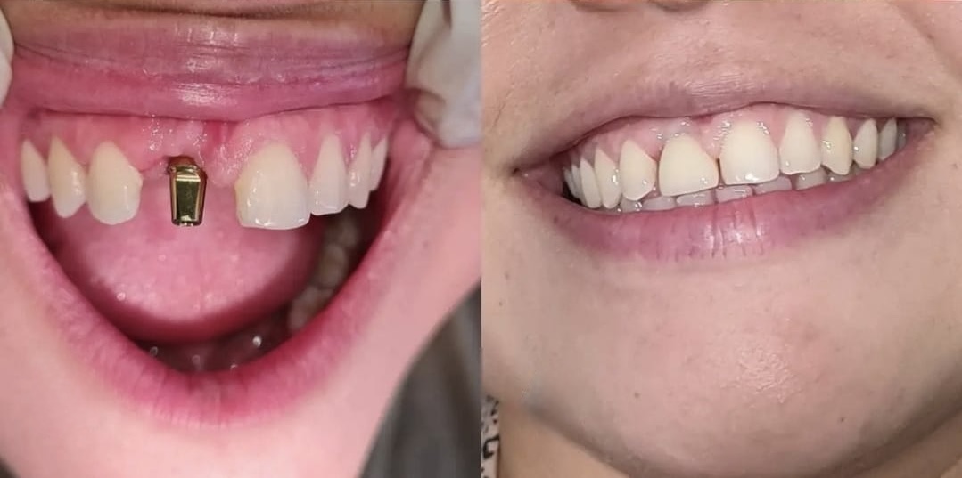 Implantes dentales todo lo que debes saber antes de iniciar tu tratamiento.