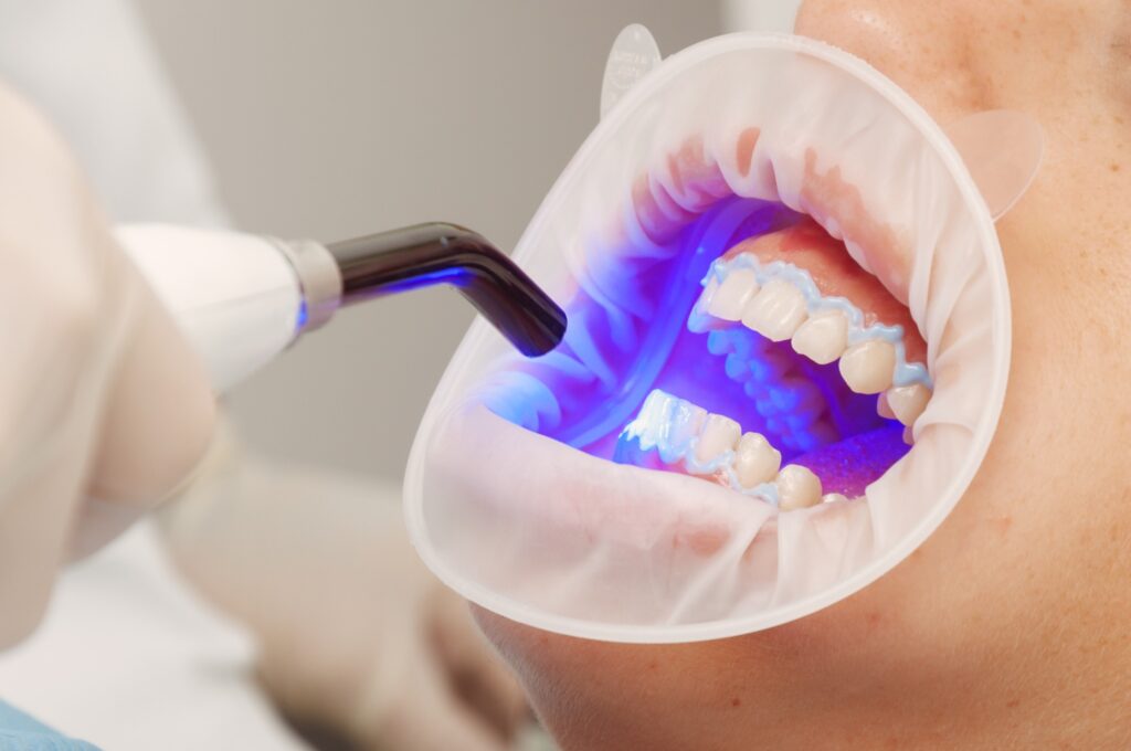 Procedimiento de blanqueamiento dental profesional en Clínica Dental Castro Romero